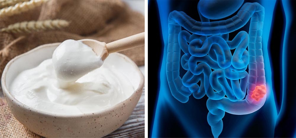 نوجوانوں میں آنتوں کے کینسر کا خطرہ، کیا دہی مفید ہے۔ شفا نیوز