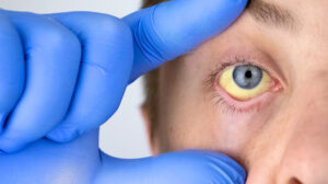 ایکیوٹ لیور فیلیر: جگر کا اچانک فیل ہو جانا