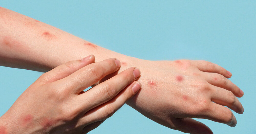 کراچی میں پہلا مقامی ایم پاکس کیس رپورٹ، بغیر سفری تاریخ مریض سامنے آگیا- شفا نیوز