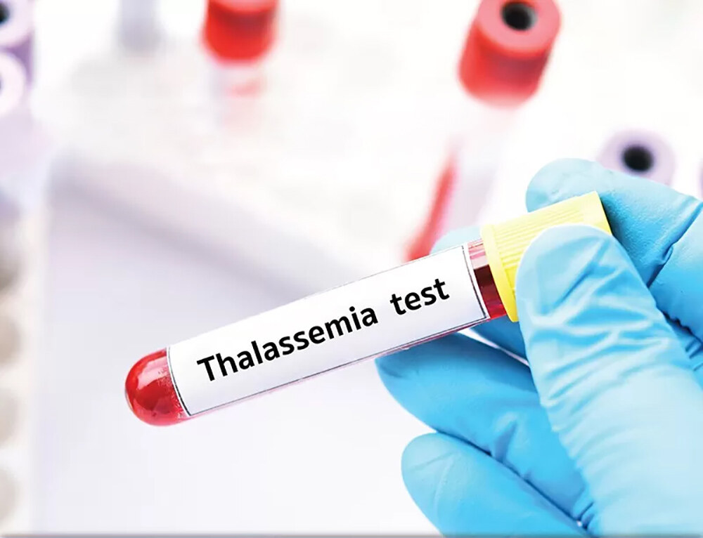 دولہا کے لیے تھیلیسیمیا ٹیسٹ لازمی قرار دینے کا بل قومی اسمبلی میں پیش- شفا نیوز