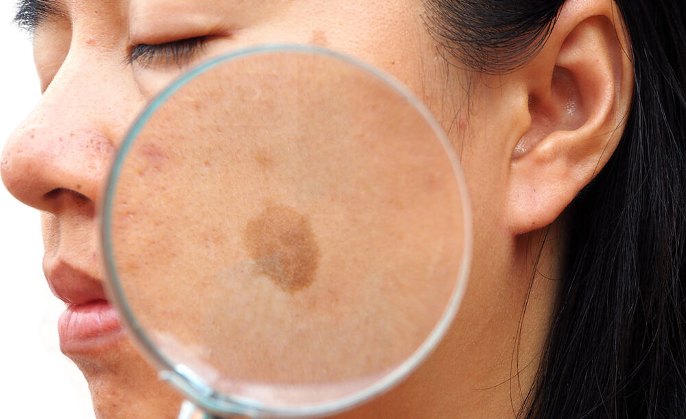 ایج سپاٹس (لیور سپاٹس) - شفا نیوز