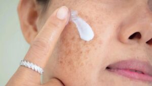 ایج سپاٹس (لیور سپاٹس) - شفا نیوز