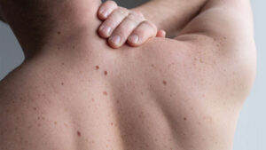 ایج سپاٹس (لیور سپاٹس) - شفا نیوز