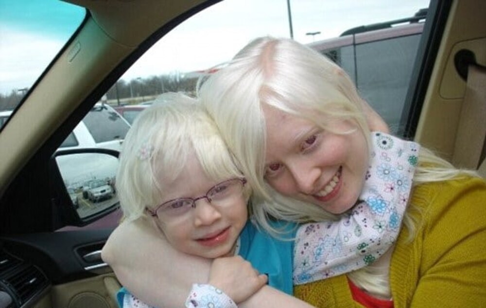 البینزم: جلد، بالوں اور آنکھوں کی رنگت نہ بننا- شفا نیوز