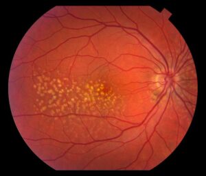 ڈرائی میکیولر ڈیجنریشن: عمر بڑھنے کےساتھ مرکزی نظر کی کمزوری- شفا نیوز