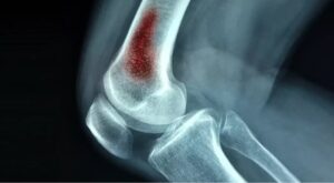 اوسٹیو مائیلائٹس: ہڈی کا انفیکشن- شفا نیوز