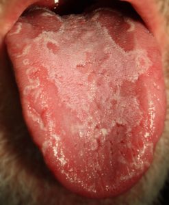 Close-up of a geographic tongue, a harmless oral condition also known as Benign Migratory Glossitis