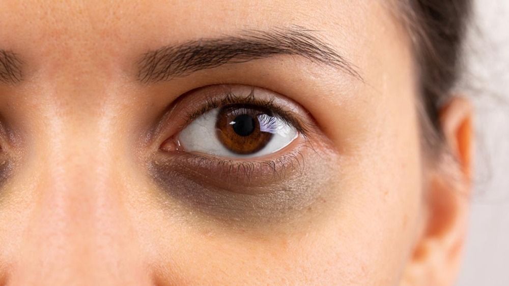آنکھوں کے گرد سیاہ حلقے