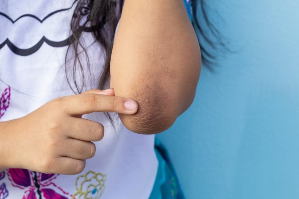 Illustration showing dark, thick, velvety skin patches on the elbow caused by acanthosis nigricans