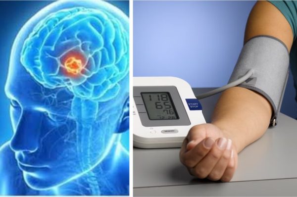 بلڈ پریشر کی عام دوا برین ٹیومر روکنے میں بھی مددگار