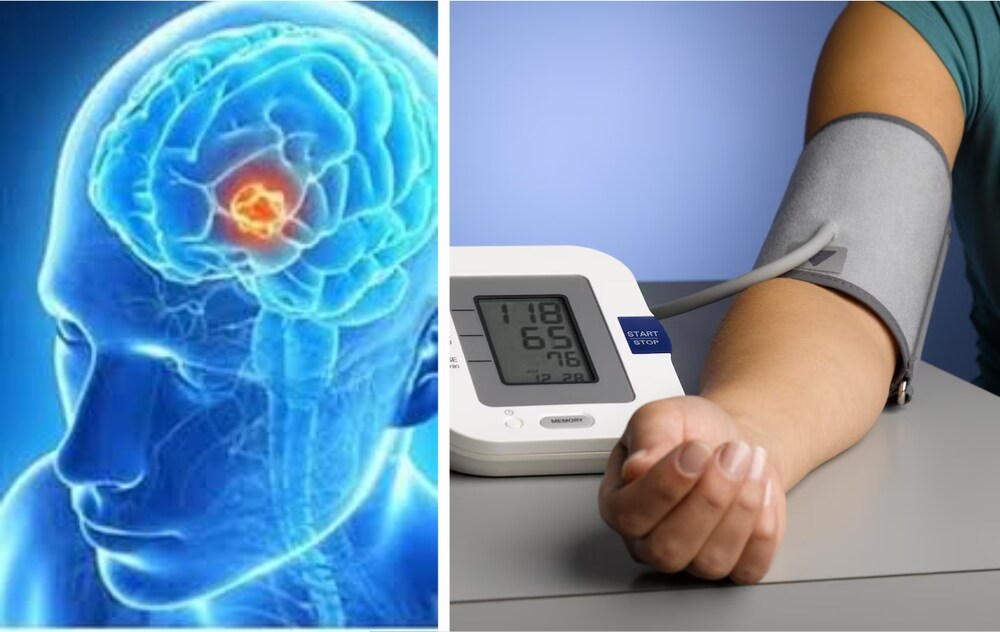 بلڈ پریشر کی عام دوا برین ٹیومر روکنے میں بھی مددگار