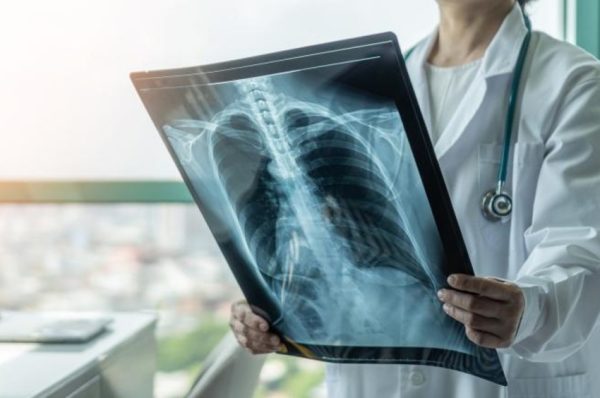 گذشتہ سال پاکستان میں ٹی بی کے 670,000 کیسز رپورٹ