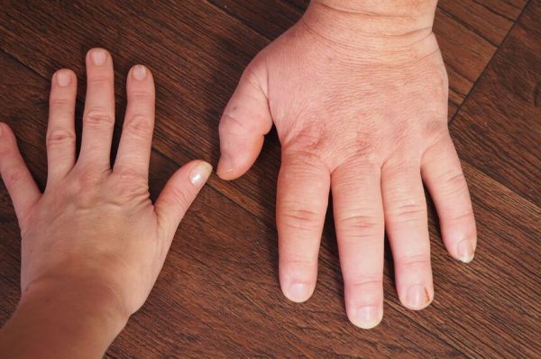 Acromegaly: Enlarged Hands, Feet, and Face