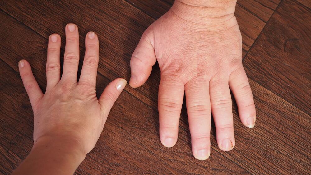 Enlarged hands representing a rare disorder, Acromegaly