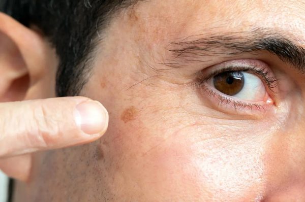 Actinic Keratosis: Sun-Damaged Patches on the Skin