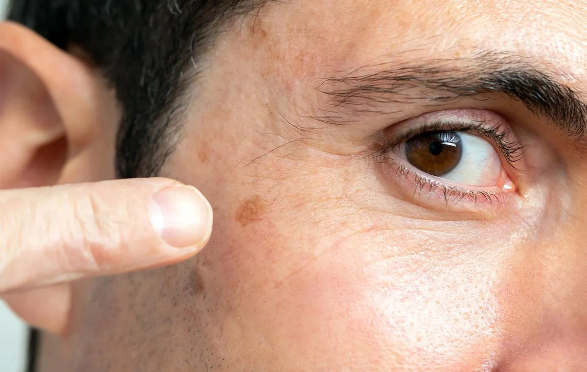 Actinic Keratosis: Sun-Damaged Patches on the Skin