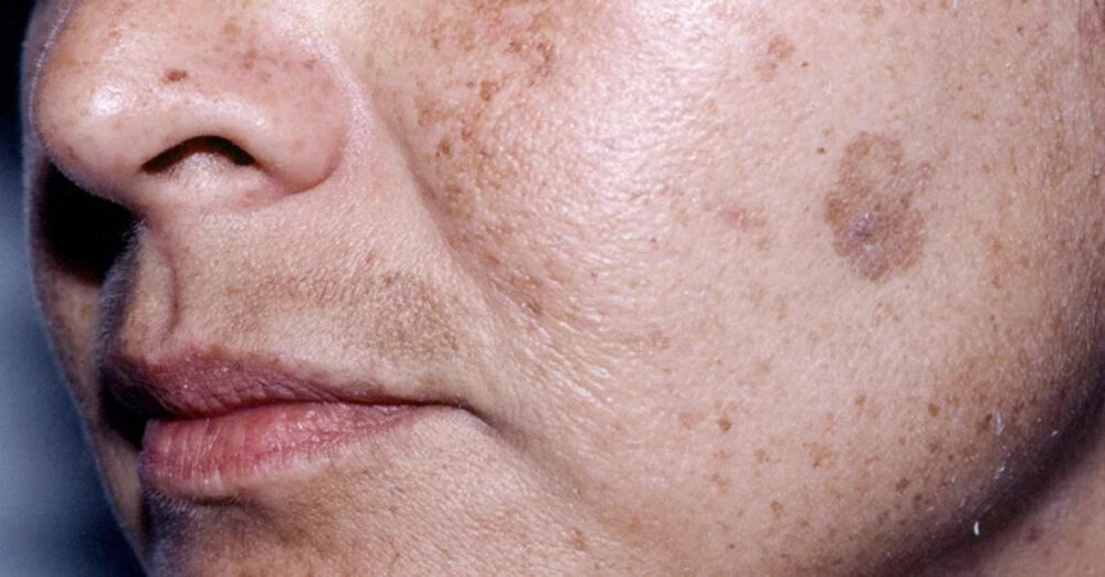 Age Spots: When Sun Exposure Leaves Its Mark