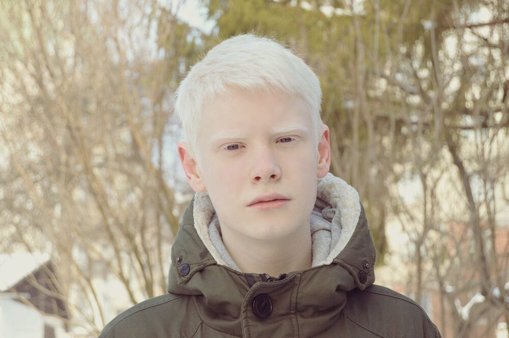 Albinism: When the Body Lacks Pigment