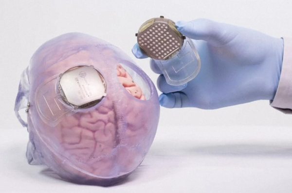 چین میں برین امپلانٹ، مفلوج افراد کے علاج میں اہم سنگ میل