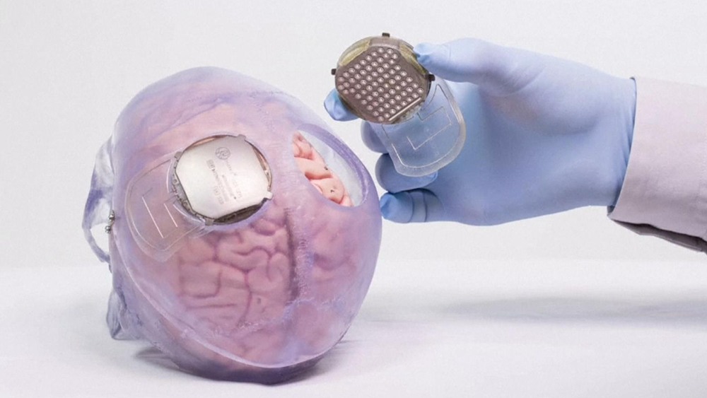 چین میں برین امپلانٹ، مفلوج افراد کے علاج میں اہم سنگ میل