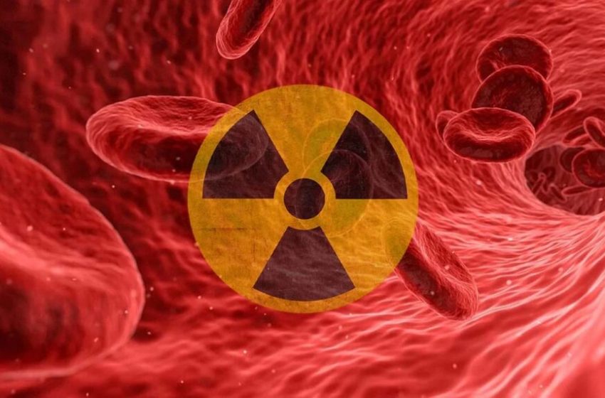 Illustration of Pap smear cells showing radiation-induced changes resembling cervical cancer, with enlarged nuclei, cytoplasmic alterations, and multinucleation.