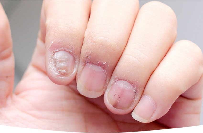 Close-up of infected nails showing discoloration, thickening, and brittleness caused by fungal infection