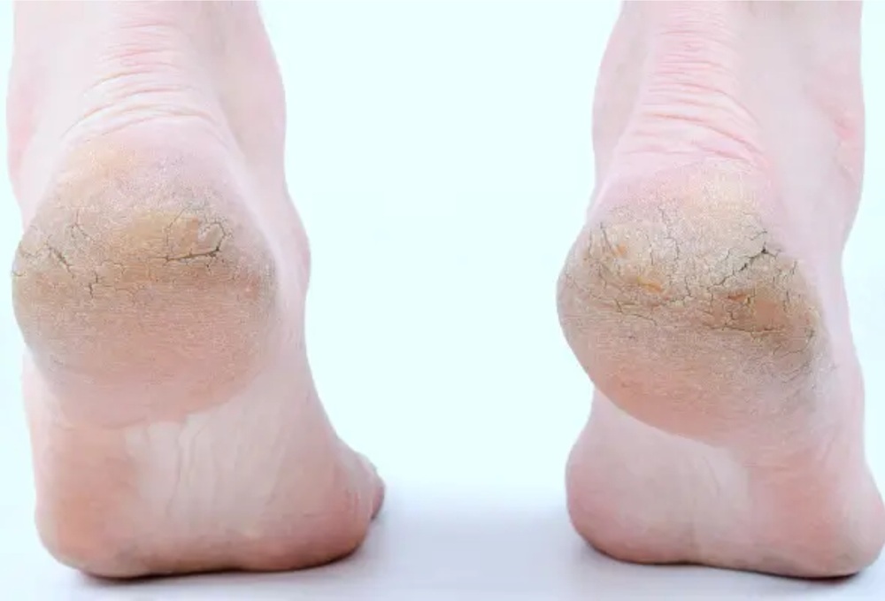 سردیوں میں ایڑیاں پھٹنے کی وجوہات کیا ہیں؟