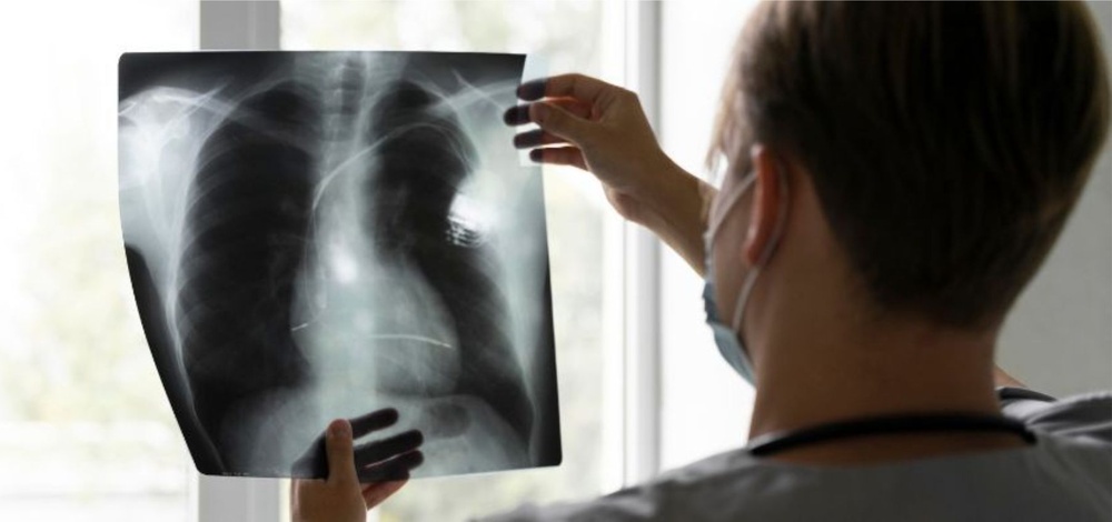 A person holding a chest X-ray in hand, showing lungs for medical examination and pneumonia diagnosis