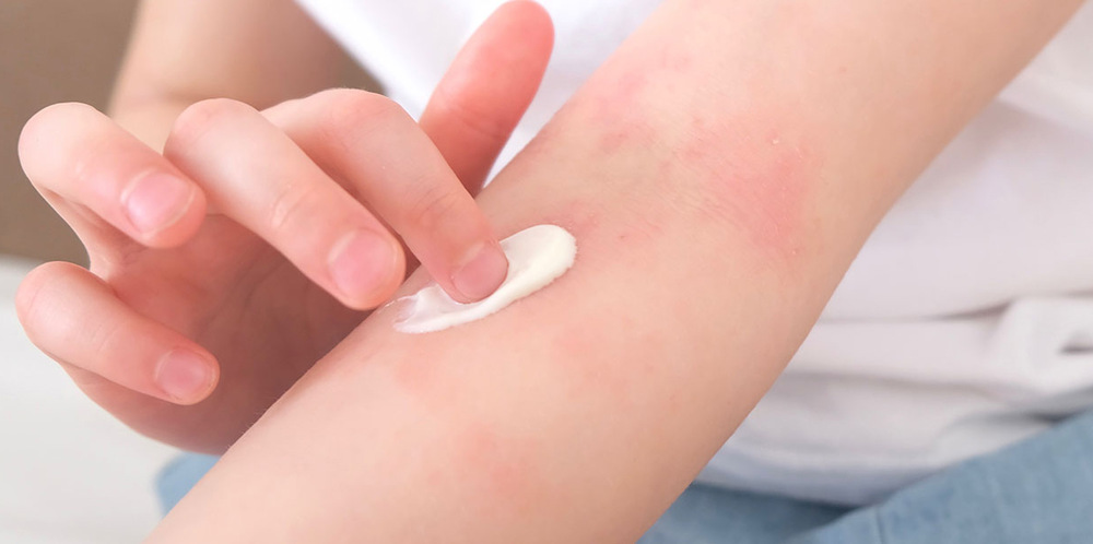 A person applying moisturizing lotion on dry skin to relieve eczema and hydrate affected areas