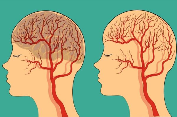 منی سٹروک کی سات علامات جنہیں نظرانداز نہ کریں، ماہرین