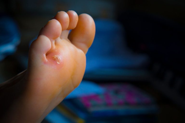 Skin Callules Corns and Calluses: Managing Thickened Skin - Shifa News International