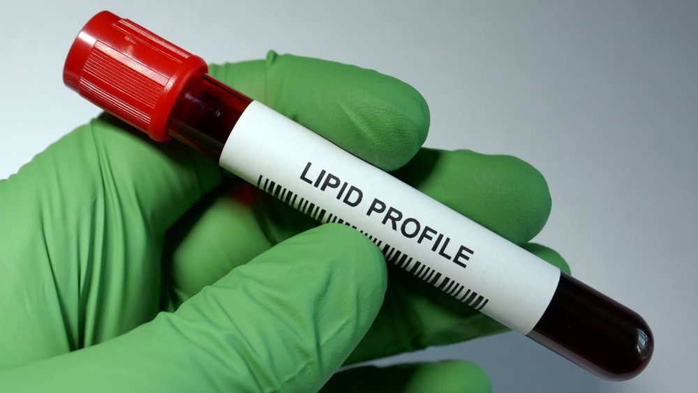 A lab technician holding a blood sample for lipid profile
