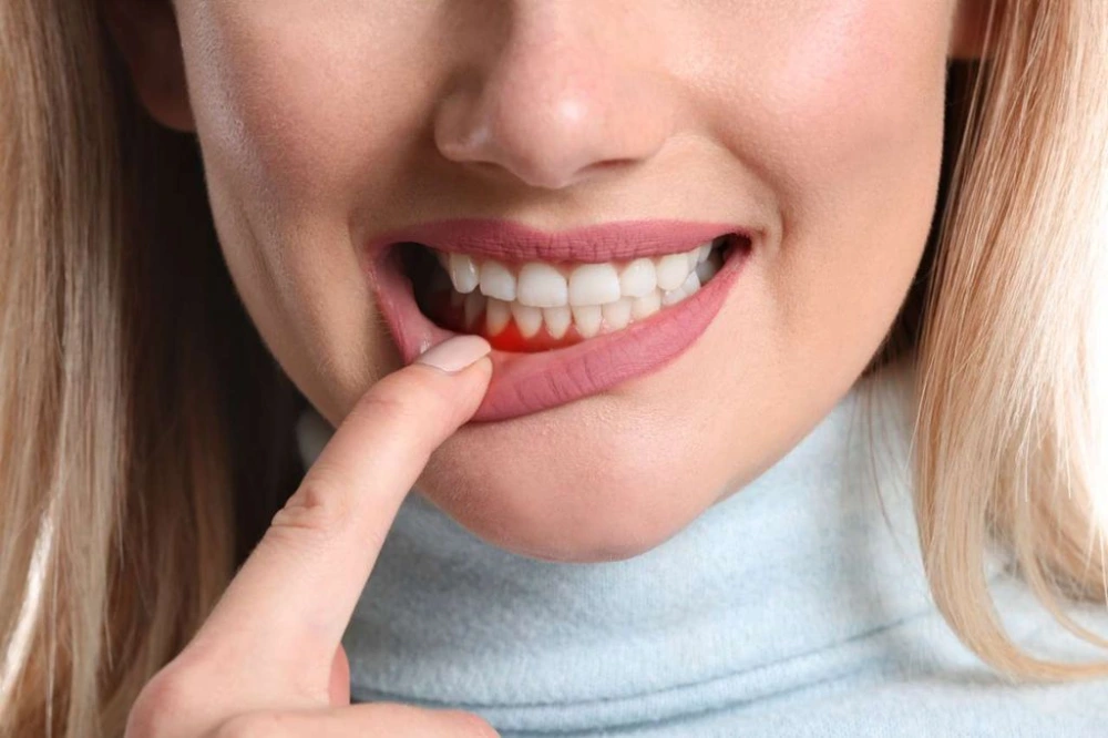 Periodontitis symptoms, gum disease, bleeding gums, diagnosis, treatment, and oral health illustration