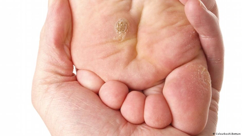 Plantar warts symptoms, HPV foot warts, diagnosis, treatment, and foot health illustration