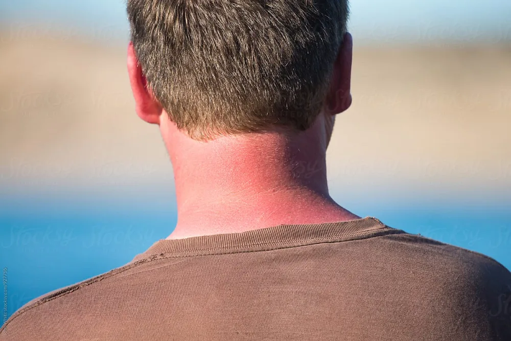 Sunburn symptoms, UV skin damage, diagnosis, treatment, and sun protection illustration