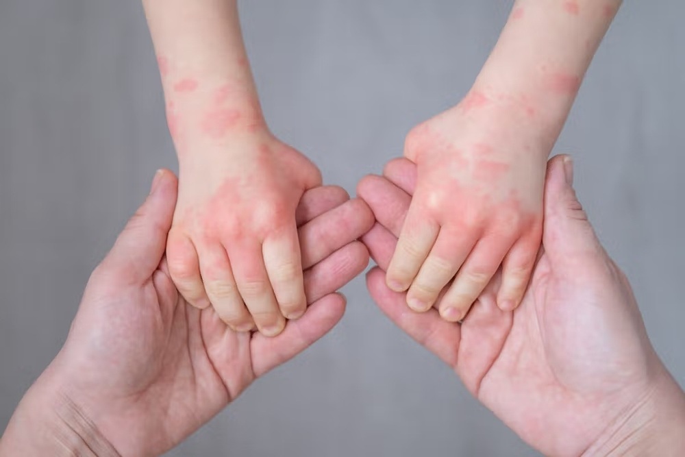 Close-up of a baby's hands with atopic dermatitis resting in the hands of an adult