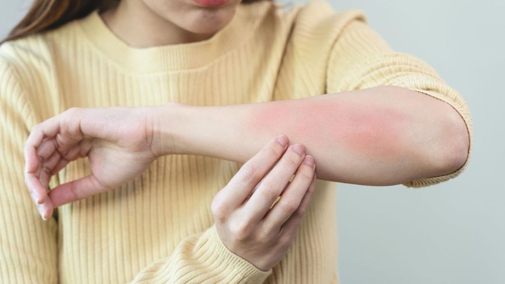 a woman with visible dermatitis symptoms on her arm, showing red, inflamed, dry, and irritated skin