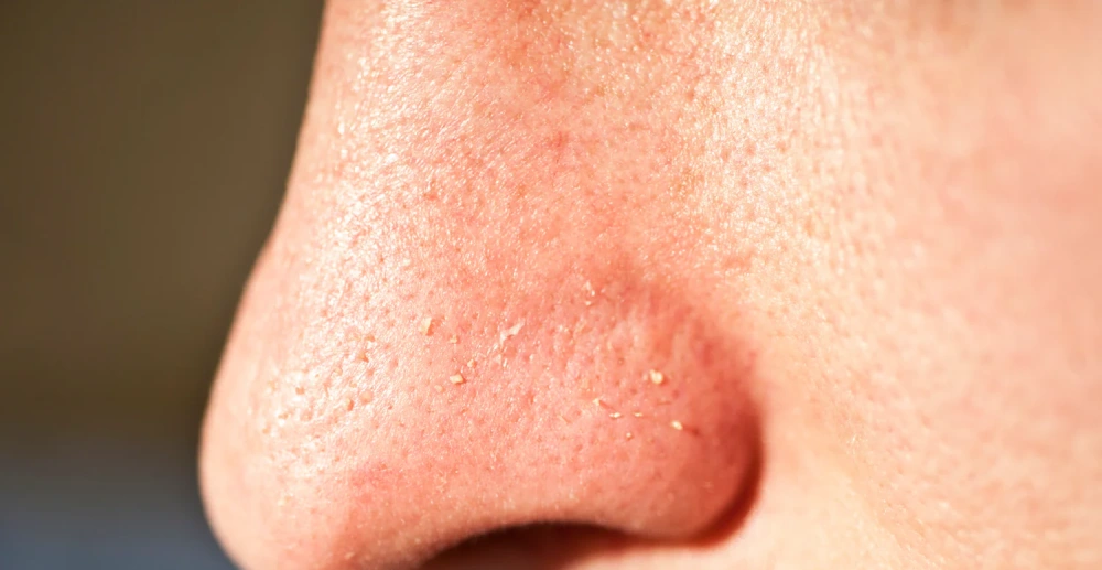 Whiteheads (closed comedones) symptoms, clogged pores, acne treatment, and skincare illustration