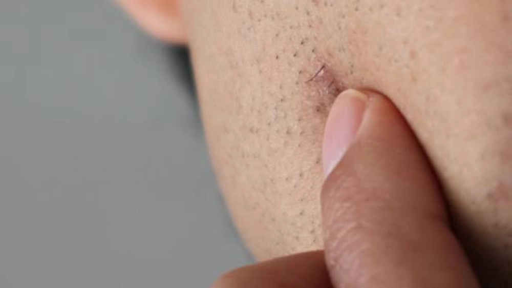 Ingrown hair symptoms, razor bumps, diagnosis, treatment, and skin health illustration