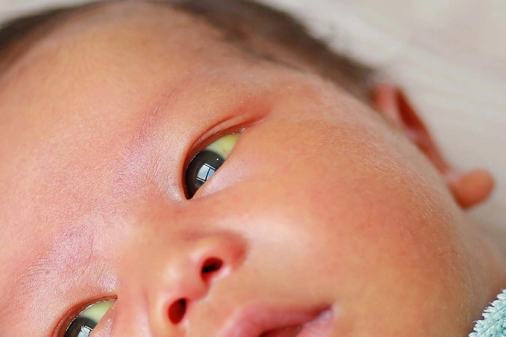 Infant jaundice symptoms, newborn jaundice, diagnosis, treatment, and newborn health illustration