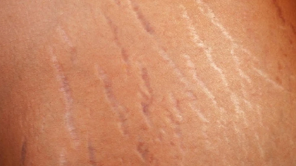 Stretch marks symptoms, skin stretching, diagnosis, treatment, and skincare illustration