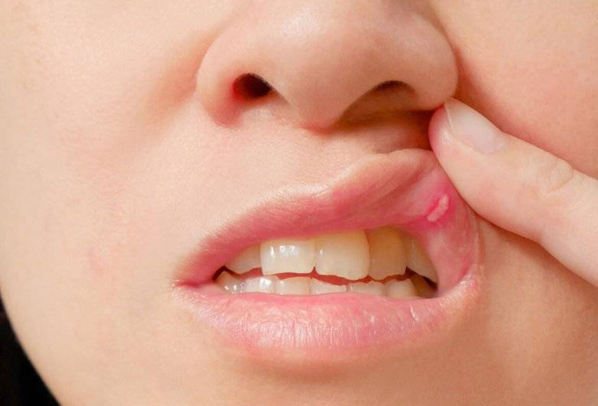 کینکر سورز: منہ کے چھالے اور زخم