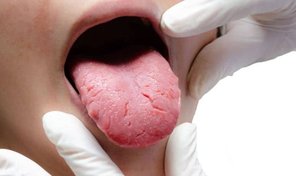 Burning Mouth Syndrome