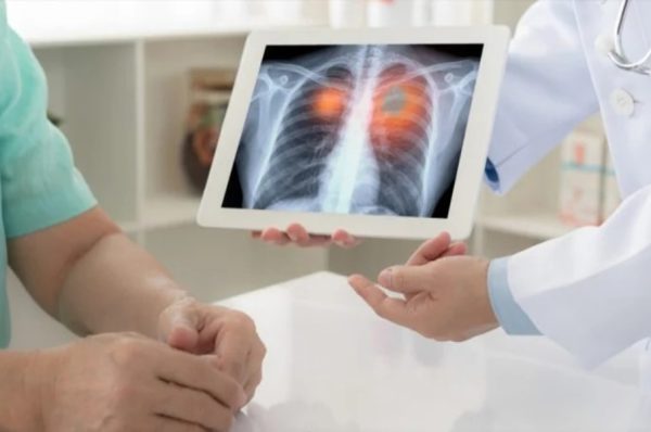 پھیپھڑوں کے کینسر کی نئی دوا کے حوصلہ افزا نتائج