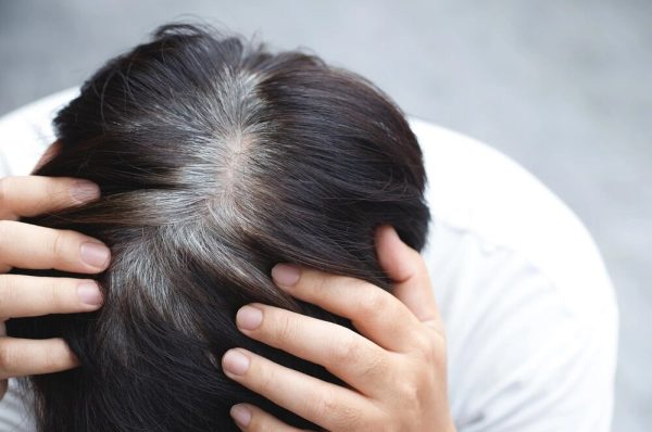 بالوں میں وقت سے پہلے سفیدی، ماہرین کی وضاحت