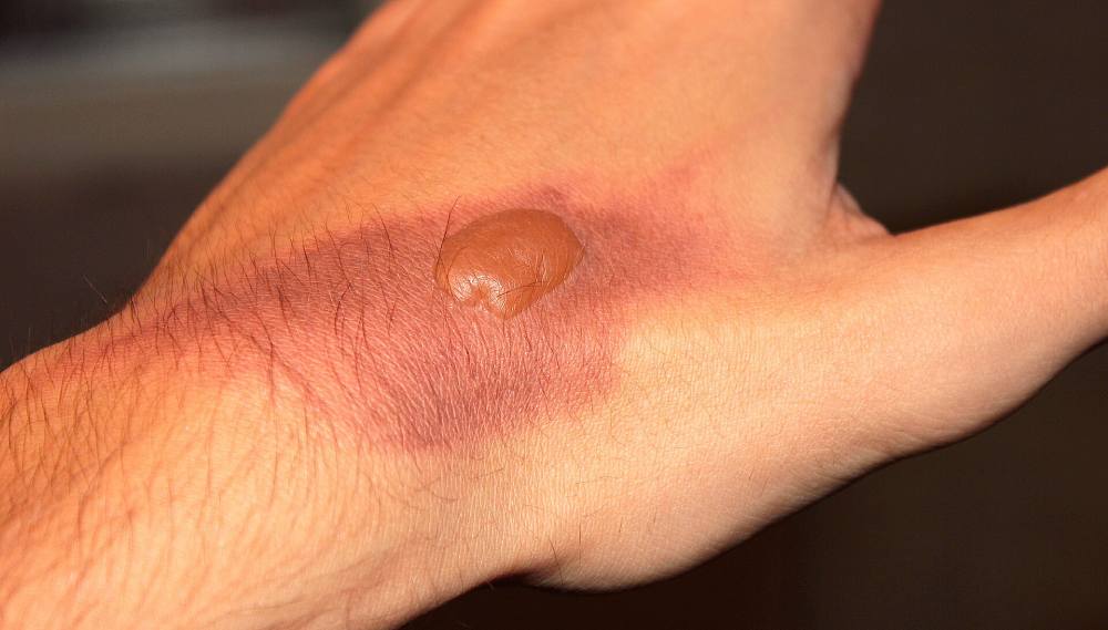 A medical illustration of skin showing a burn injury with a localized red, irritated area, symbolizing skin damage caused by burns.